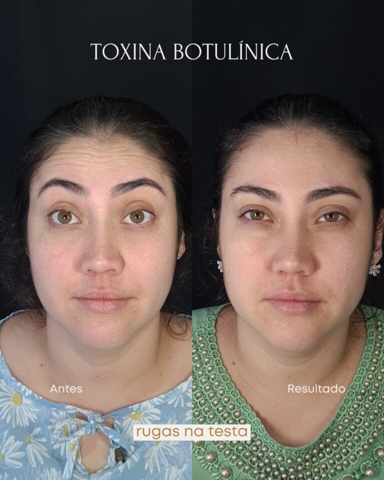botox (9)